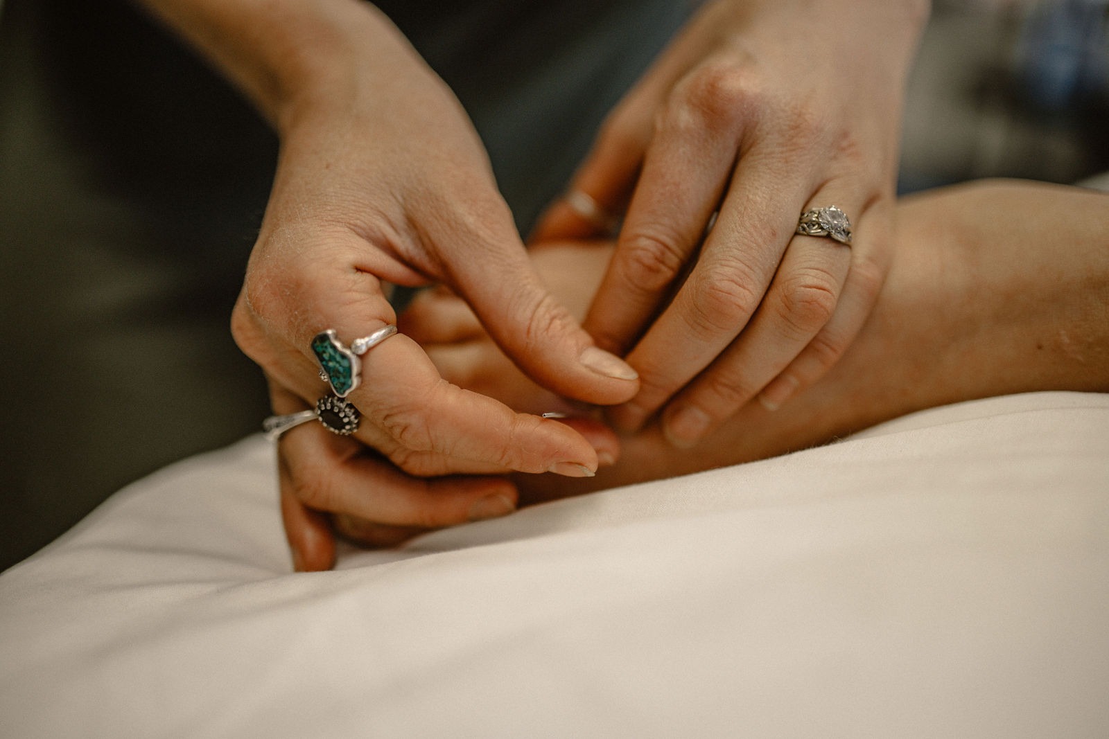 Acupuncture needles being placed